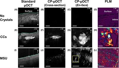 Imaging human coronary cholesterol/urate crystals with cross-polarized micro-optical coherence tomography